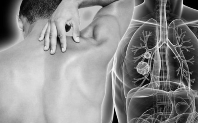 Is Upper Back Pain a Sign of Lung Cancer? Other types of cancer could cause back pain, too