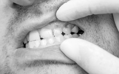 Dental hypoplasia: What causes it and ways to manage