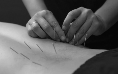 Dry Needling: What It Is and How It Works